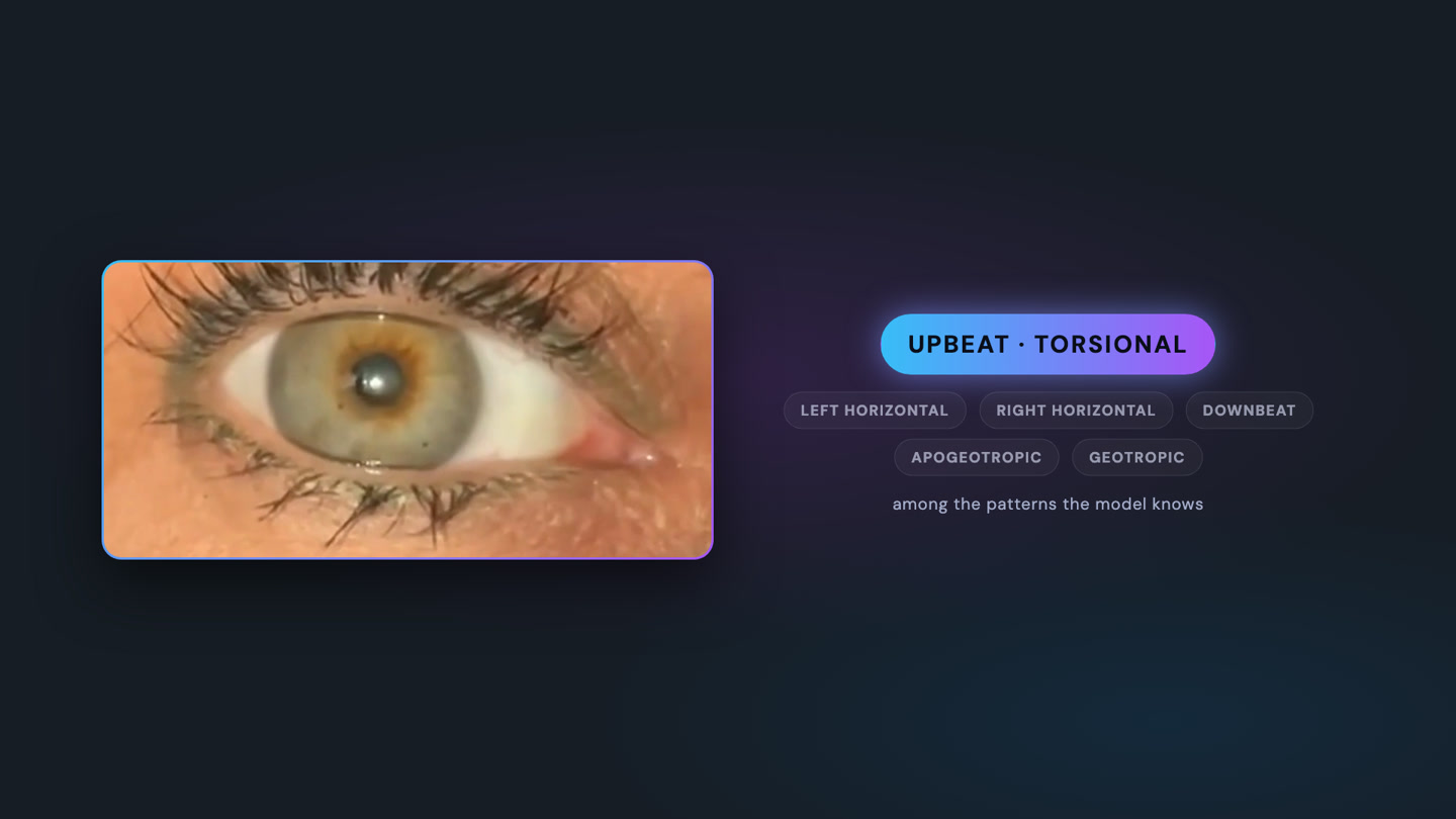 The real eye recording in a phone frame, the pattern "upbeat torsional" identified among the patterns the model knows