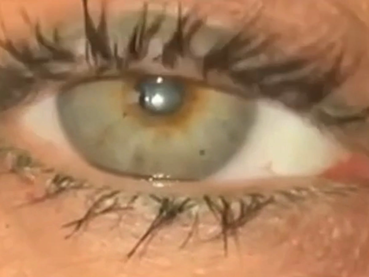 A close-up of an eye from a SmartVertigo recording